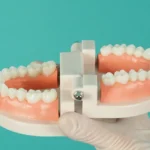 Denizli kliniğimizde uygulanan All-on-4 ve All-on-6 tam çene sabit implant tedavisi.