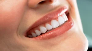 Denizli kliniğimizde uygulanan ışık geçirgenliği yüksek zirkonyum kaplama ve restorasyon süreci.