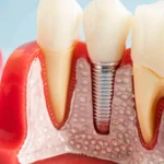 Dent Denizli Diş Kliniği Dental İmplant Bilgilendirme ve Muayene Alanı