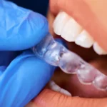 Denizli kliniğimizde uygulanan dijital telsiz ortodonti ve Şeffaf Plak (Invisalign) uygulama aşamaları.