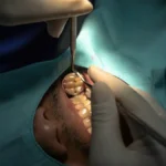 Denizli kliniğimizde implant öncesi uygulanan sinüs lifting (sinüs yükseltme) cerrahisi.