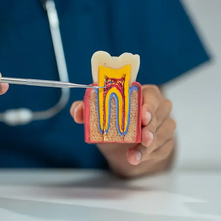 Denizli kliniğimizde diş kurtarma amacıyla uygulanan kanal tedavisi aşamaları ve kök kanal dolgusu.